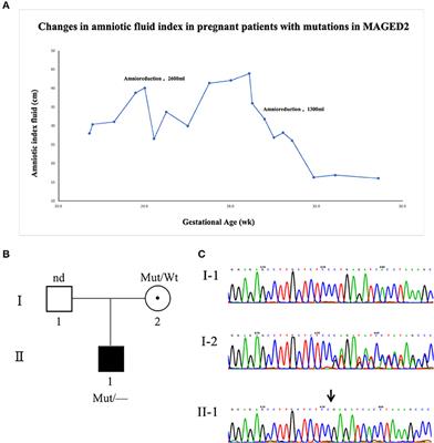 A Case Report and Literature Review of a Novel Mutation in the MAGED2 Gene of a Patient With Severe Transient Polyhydramnios